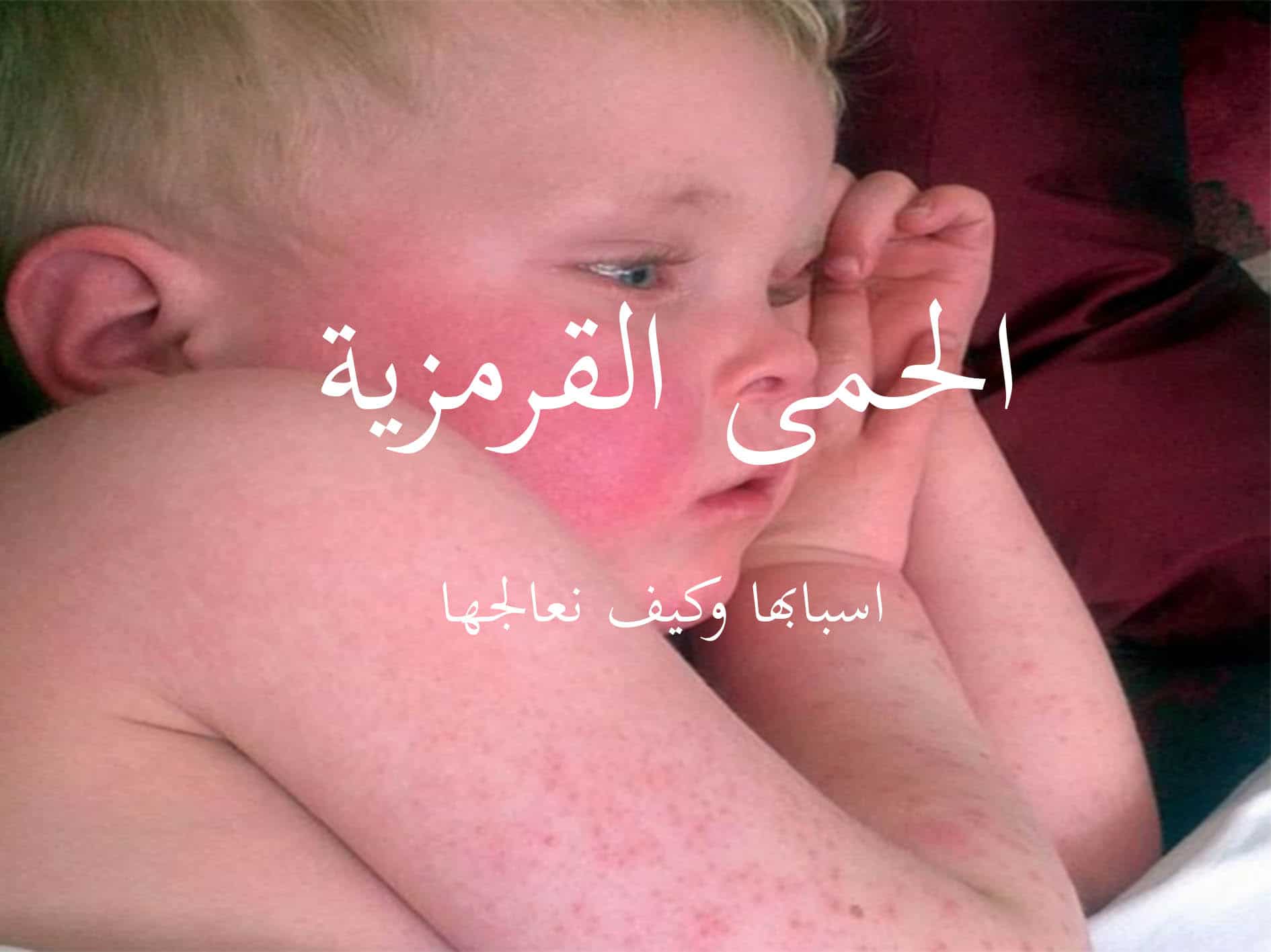 الحمى القرمزية